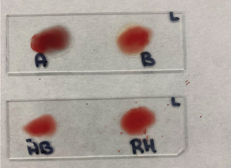 Resultado determinación de grupos sanguíneos AB0 y Rh